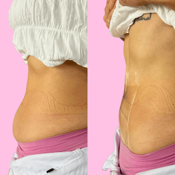 Tersa Lift™ | Panza