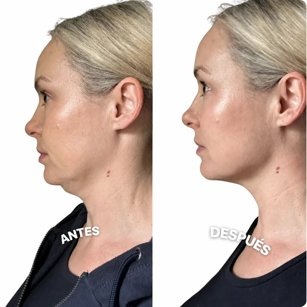 Antes y después cuello