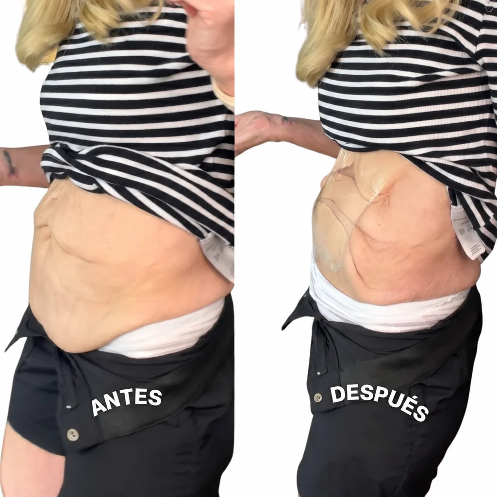 Antes y después panza